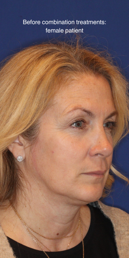 Liquid Facelift Before & After Patient #15788