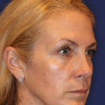 Liquid Facelift Before & After Patient #15788