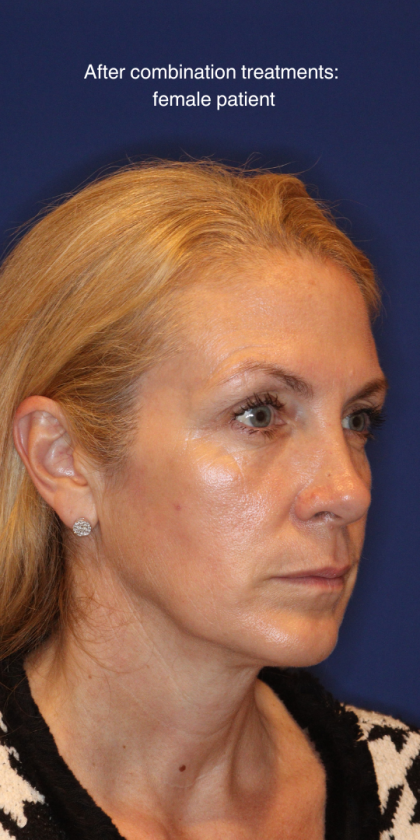 Liquid Facelift Before & After Patient #15788