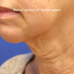 Facelift / Neck Lift Before & After Patient #15749
