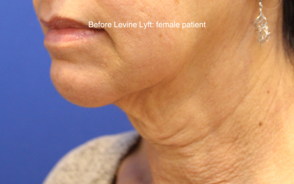Facelift / Neck Lift Before & After Patient #15749
