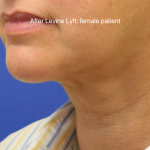 Facelift / Neck Lift Before & After Patient #15749