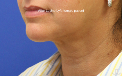 Facelift / Neck Lift Before & After Patient #15749