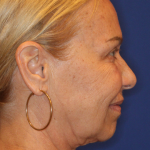 Facelift / Neck Lift Before & After Patient #15100