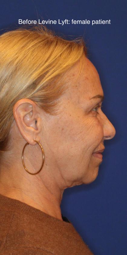 Facelift / Neck Lift Before & After Patient #15100
