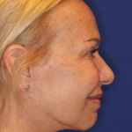 Facelift / Neck Lift Before & After Patient #15100