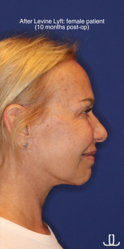 Facelift / Neck Lift Before & After Patient #15100