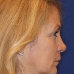 Liquid Facelift Before & After Patient #15788
