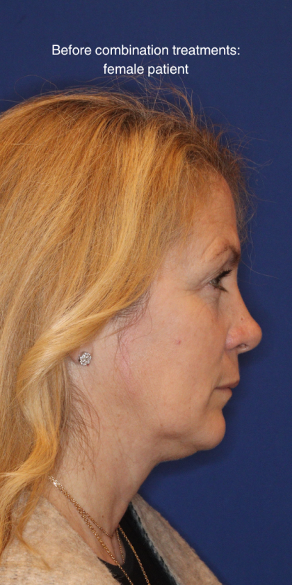 Liquid Facelift Before & After Patient #15788