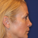 Liquid Facelift Before & After Patient #15788