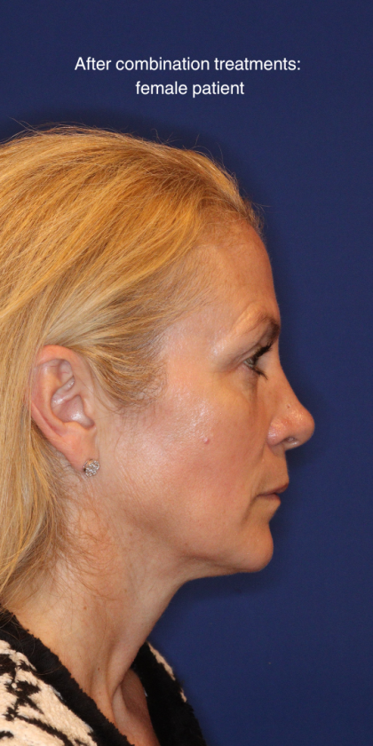 Liquid Facelift Before & After Patient #15788