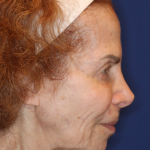 Facelift / Neck Lift Before & After Patient #15094