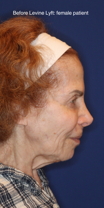 Facelift / Neck Lift Before & After Patient #15094