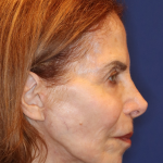 Facelift / Neck Lift Before & After Patient #15094