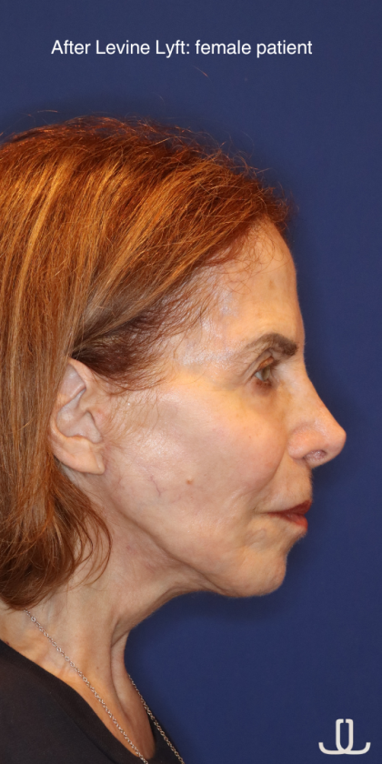 Facelift / Neck Lift Before & After Patient #15094