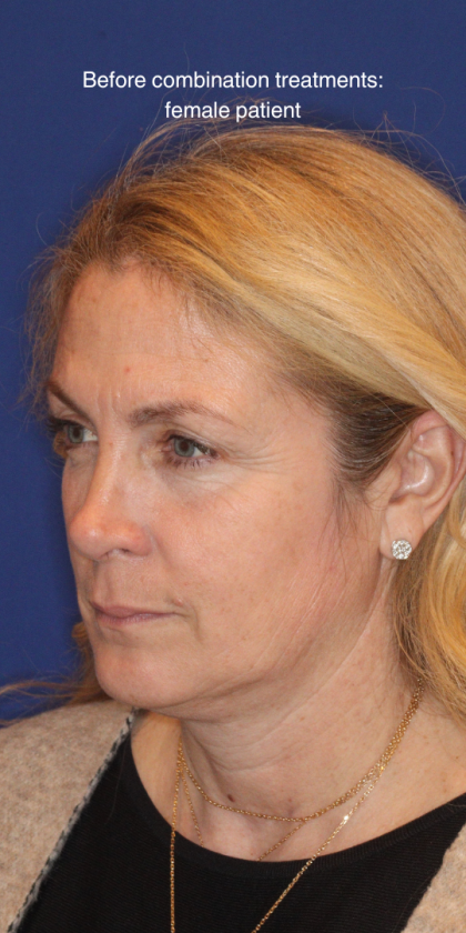 Liquid Facelift Before & After Patient #15788