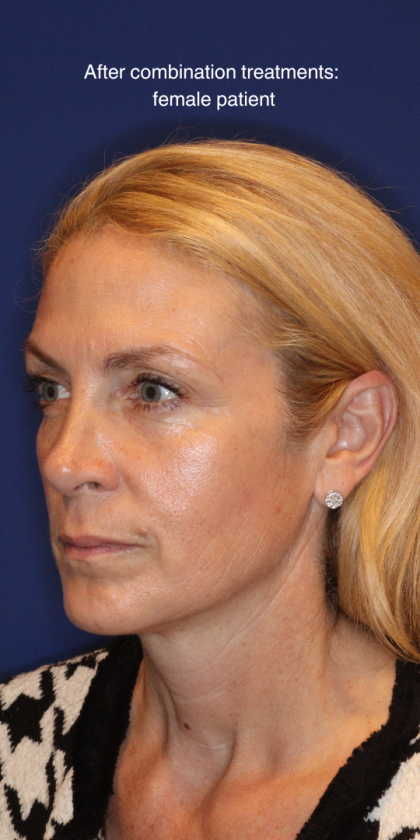 Liquid Facelift Before & After Patient #15788