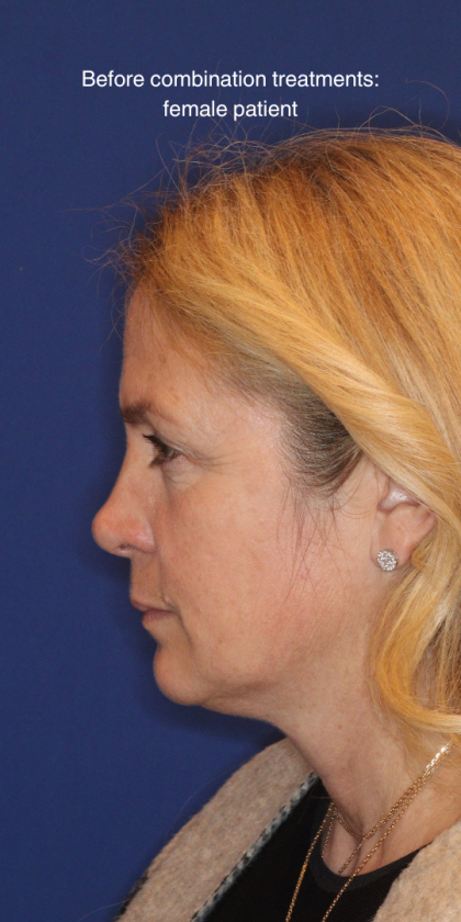 Liquid Facelift Before & After Patient #15788
