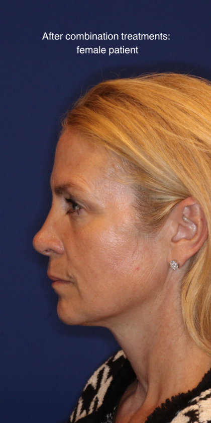 Liquid Facelift Before & After Patient #15788