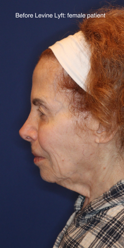 Facelift / Neck Lift Before & After Patient #15094