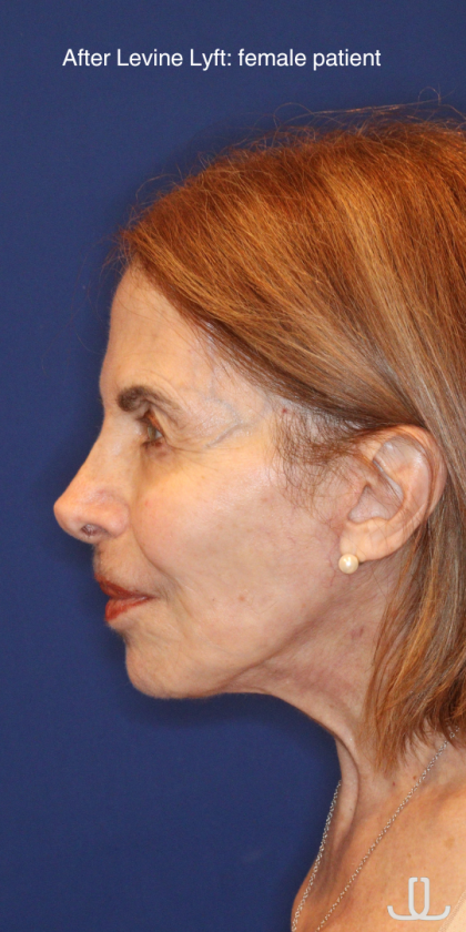 Facelift / Neck Lift Before & After Patient #15094