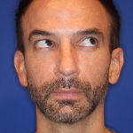 Otoplasty Before & After Patient #13919