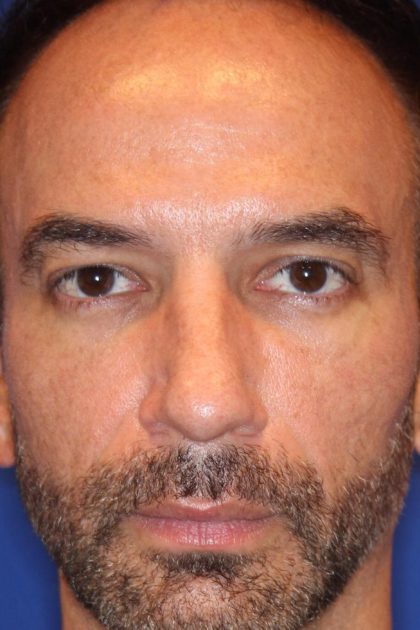 Otoplasty Before & After Patient #13919