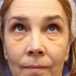 Otoplasty Before & After Patient #13911