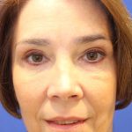 Otoplasty Before & After Patient #13911