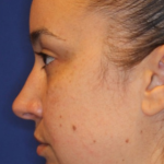 Chin Augmentation Before & After Patient #13352
