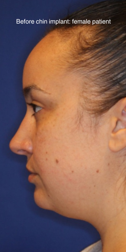 Chin Augmentation Before & After Patient #13352