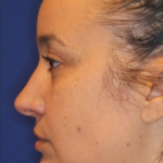 Chin Augmentation Before & After Patient #13352