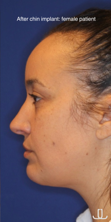 Chin Augmentation Before & After Patient #13352