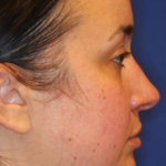 Chin Augmentation Before & After Patient #13352