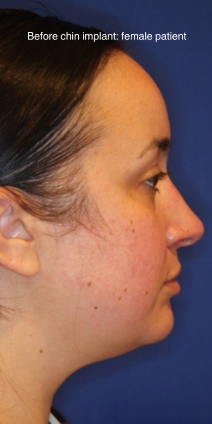 Chin Augmentation Before & After Patient #13352