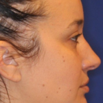 Chin Augmentation Before & After Patient #13352