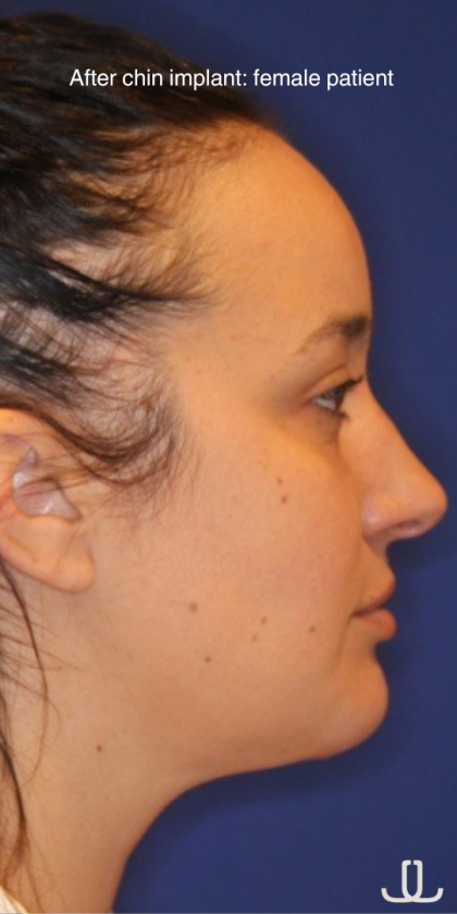 Chin Augmentation Before & After Patient #13352