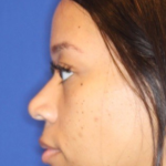 Chin Augmentation Before & After Patient #13350