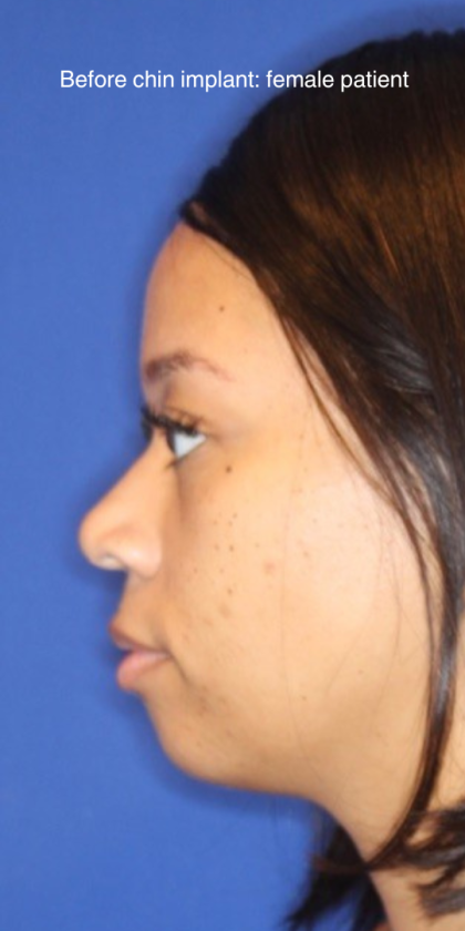 Chin Augmentation Before & After Patient #13350