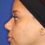 Chin Augmentation Before & After Patient #13350