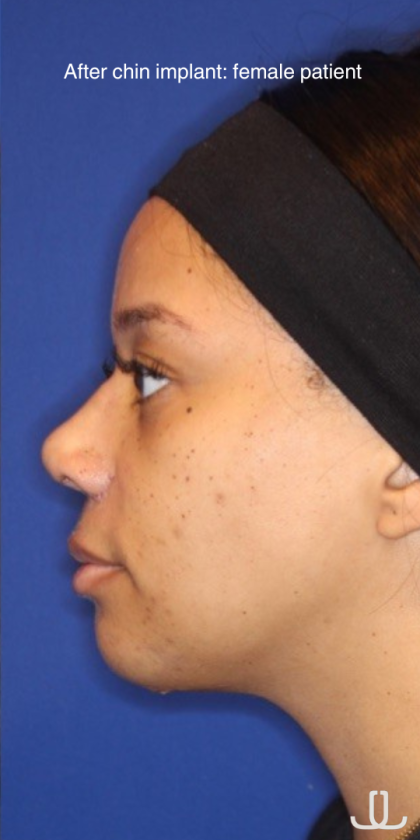 Chin Augmentation Before & After Patient #13350