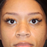 Chin Augmentation Before & After Patient #13350