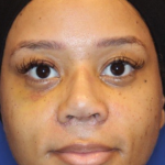 Chin Augmentation Before & After Patient #13350