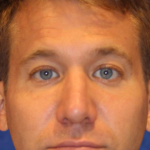 Chin Augmentation Before & After Patient #13353