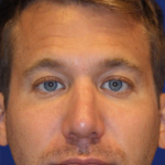 Chin Augmentation Before & After Patient #13353