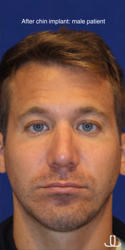 Chin Augmentation Before & After Patient #13353