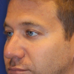 Chin Augmentation Before & After Patient #13353
