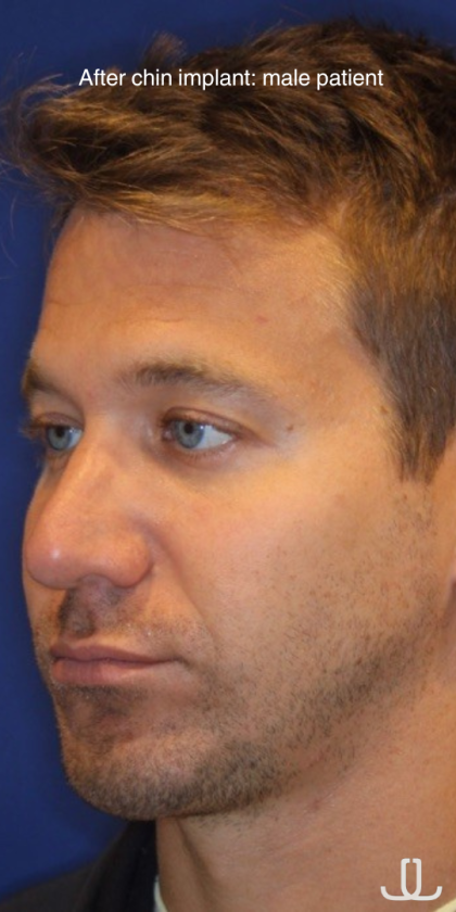 Chin Augmentation Before & After Patient #13353
