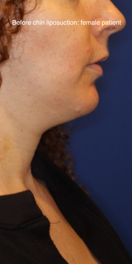 Chin Liposuction Before & After Patient #15735