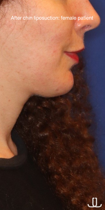 Chin Liposuction Before & After Patient #15735